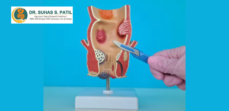 Piles Doctor in Pimpri Chinchwad | Dr. Suhas S. Patil